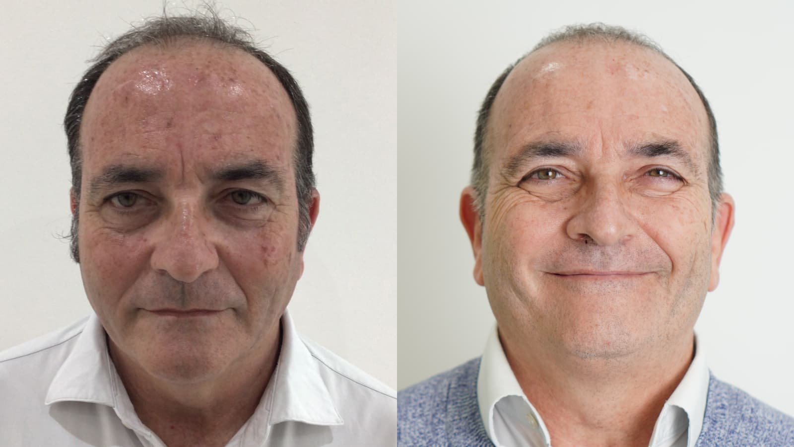 What We’ve Learned About Age Spots After Treating London and Essex Clients