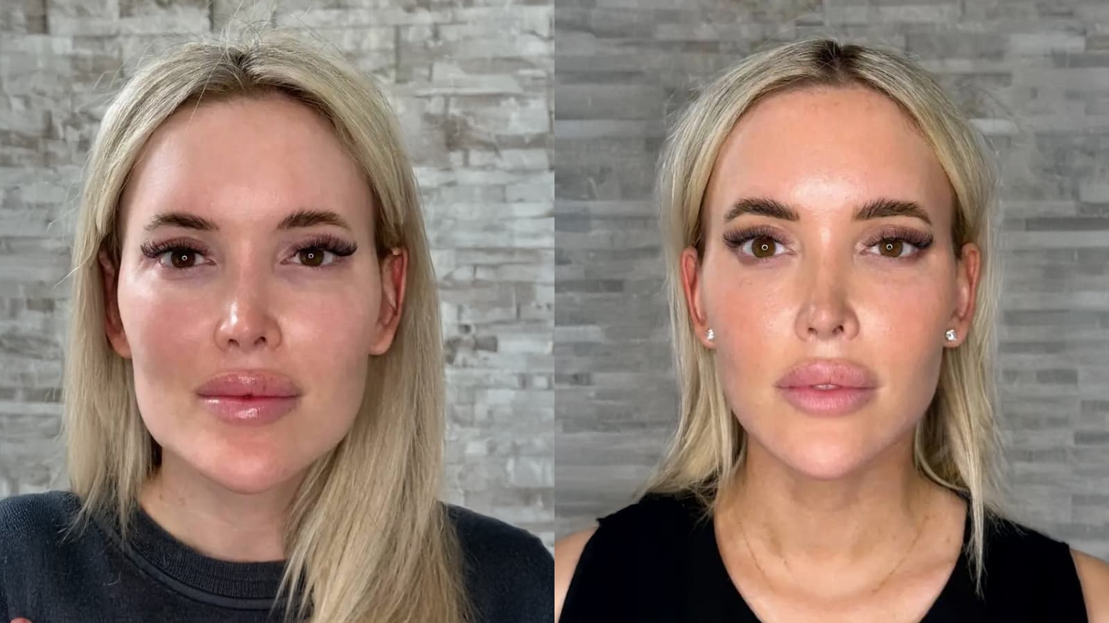 What Dermal Fillers Actually Do To Your Face