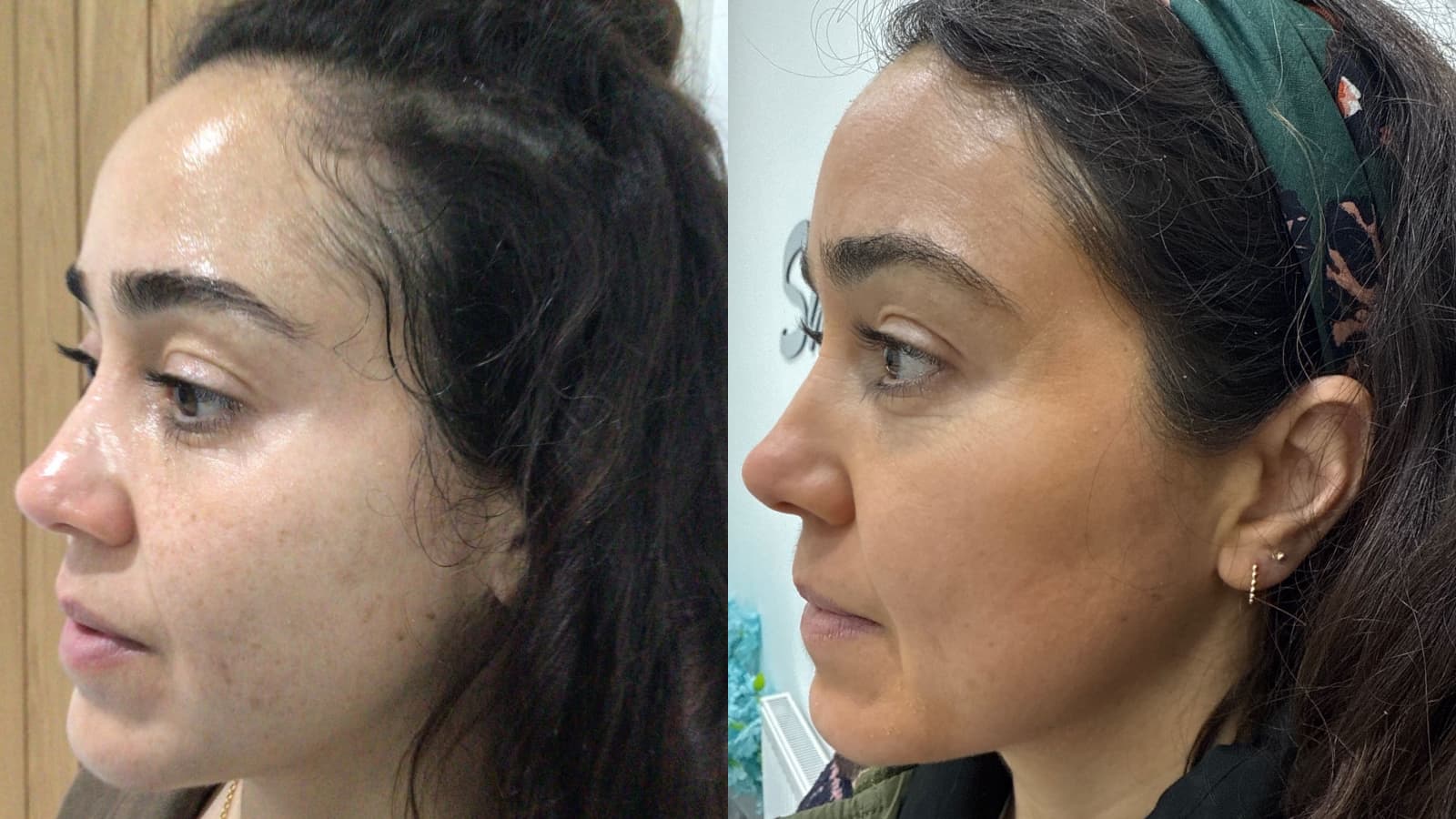 Why Professional Hyperpigmentation Treatment Actually Works