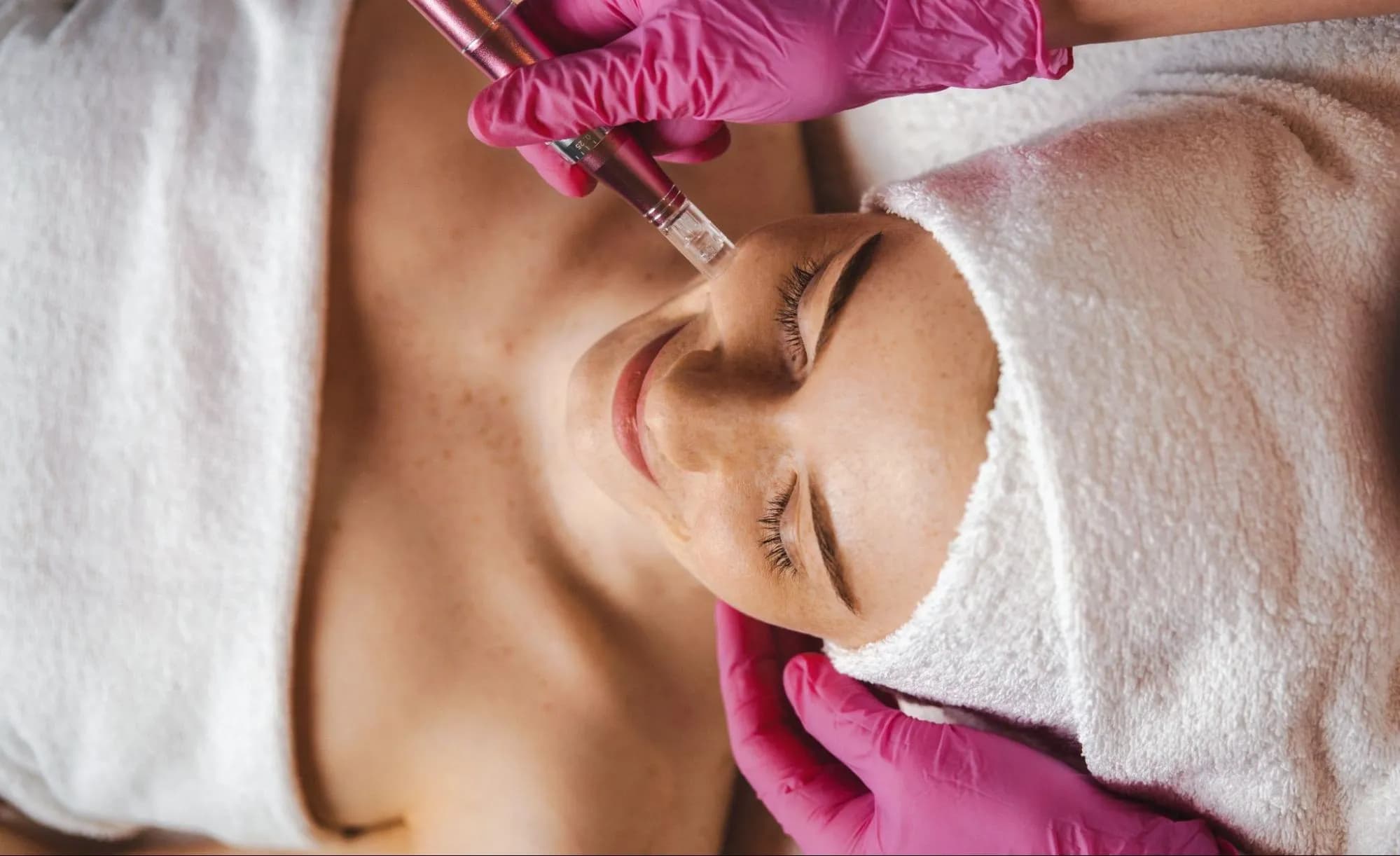 Microneedling Facial being performed on a female client’s face at a professional skincare clinic