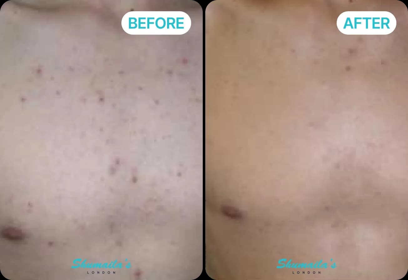 Acne Scar Treatment