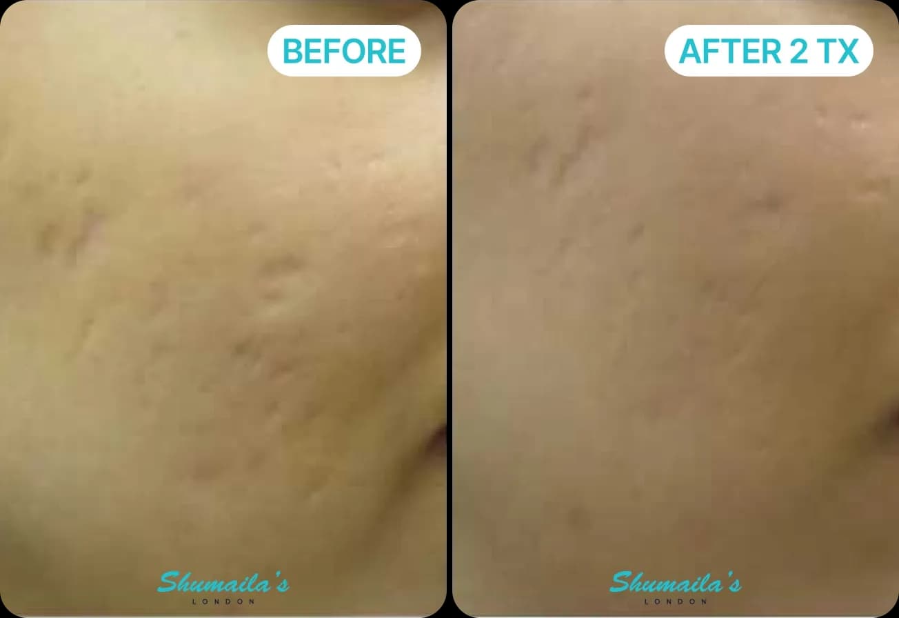Acne Scar Treatment