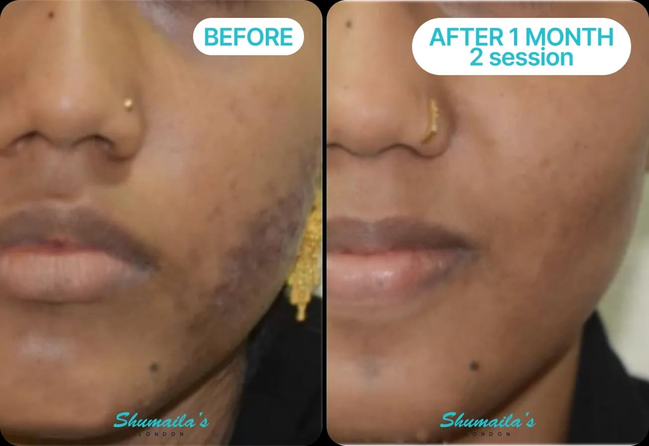Acne Scar Treatment