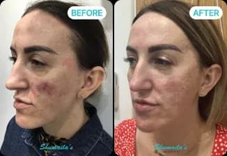 Acne Scar Treatment