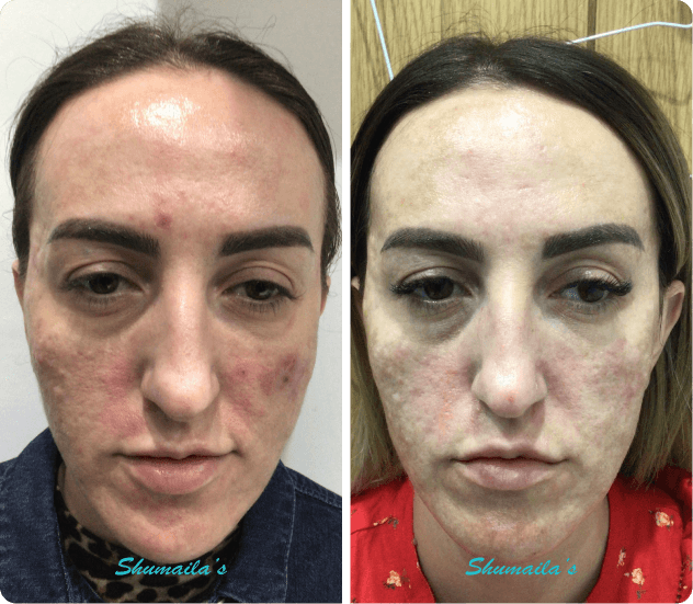 Acne Scar Treatment