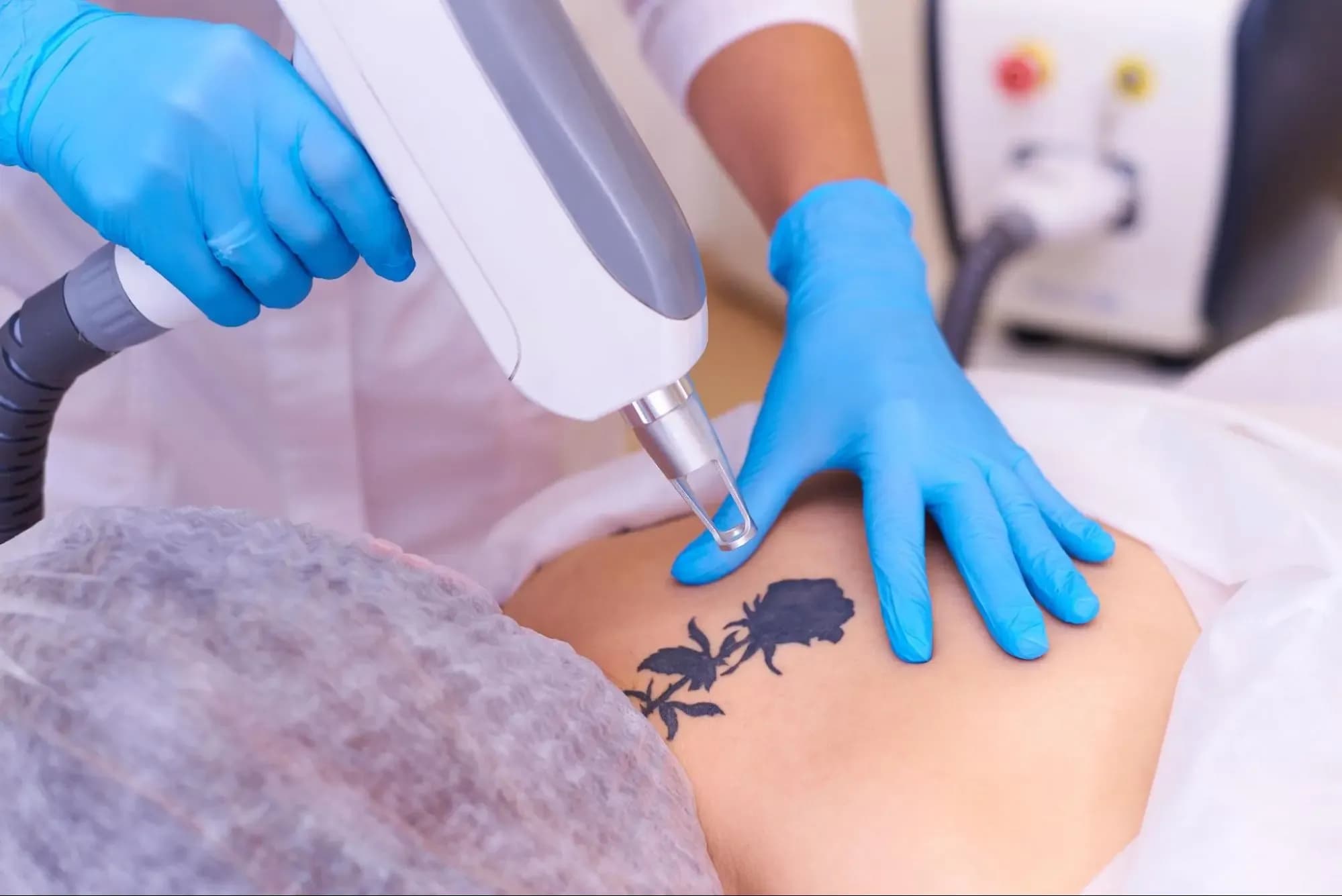 Laser tattoo removal on woman’s back using advanced cosmetic equipment