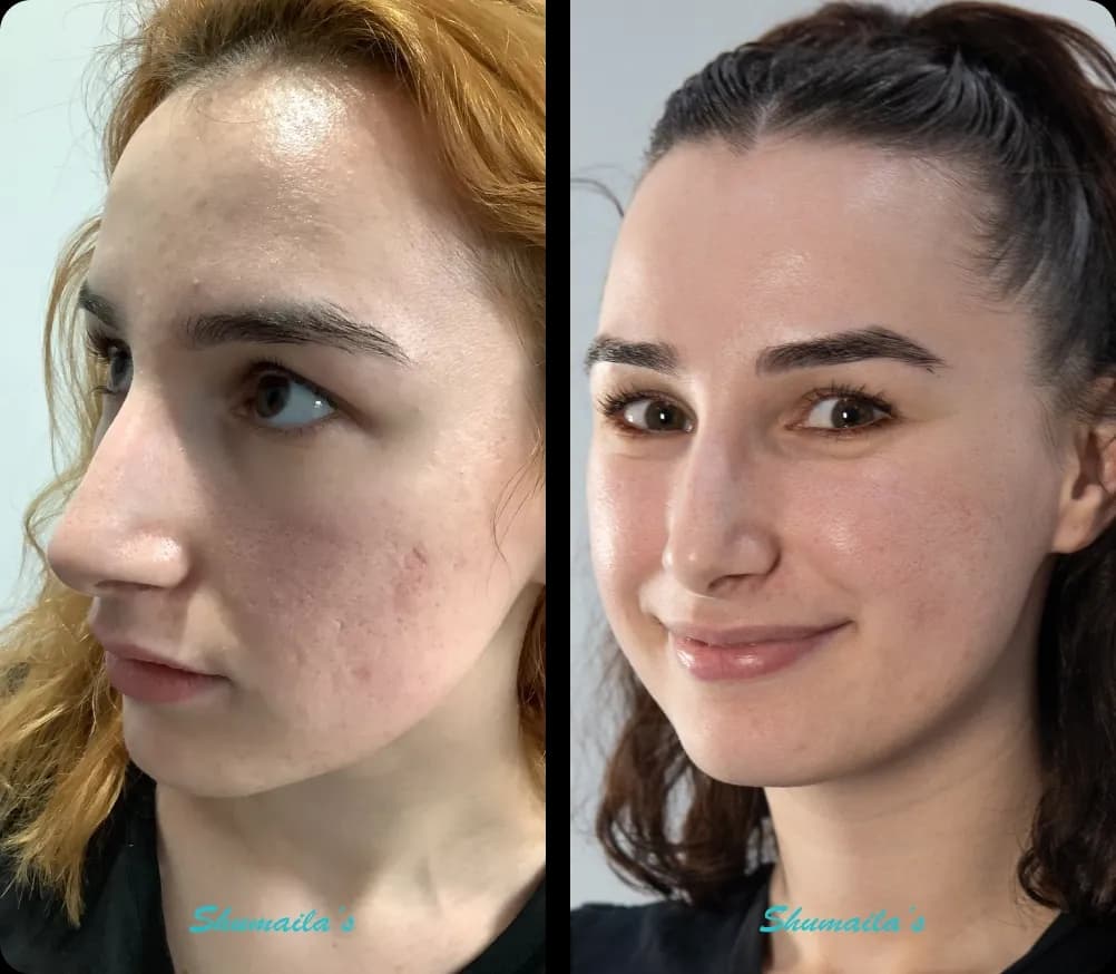 Acne Scar Treatment