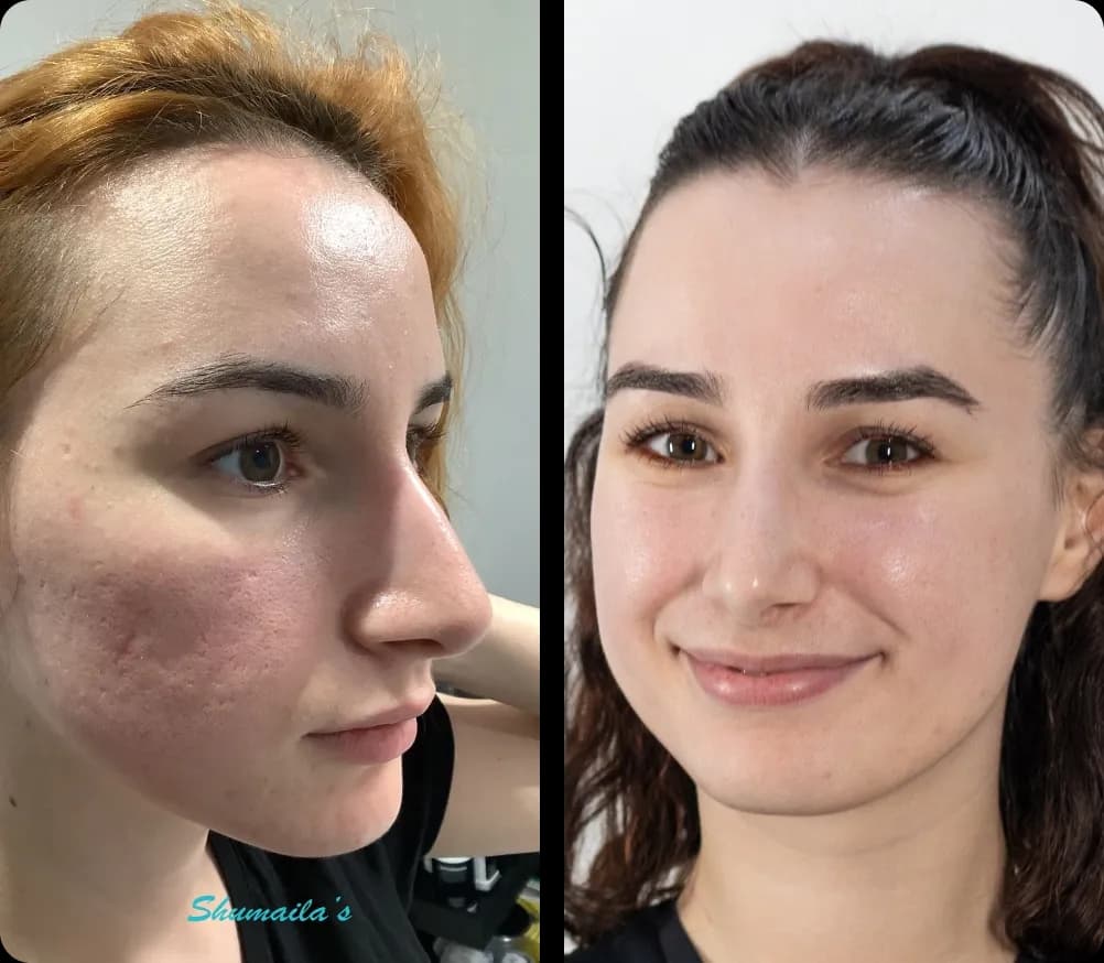 Acne Scar Treatment