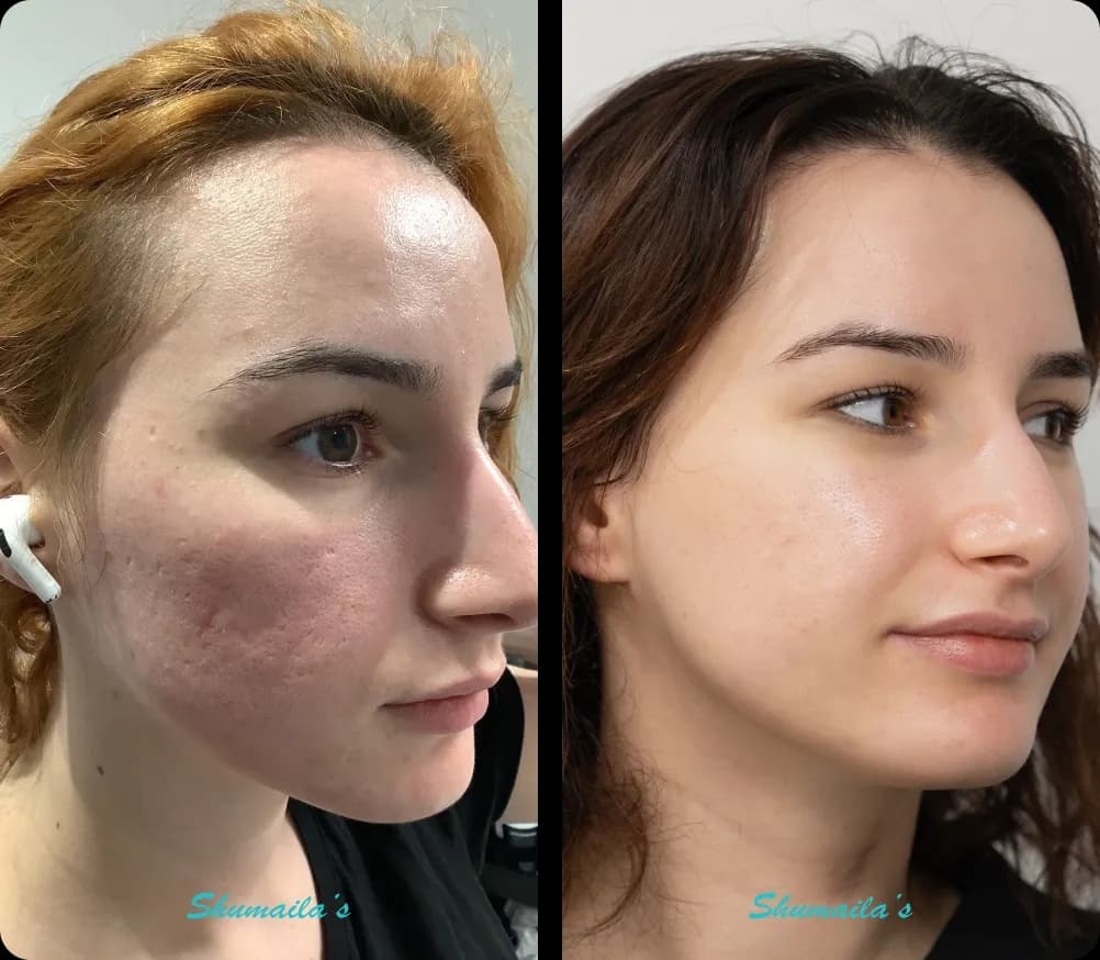 Acne Scar Treatment