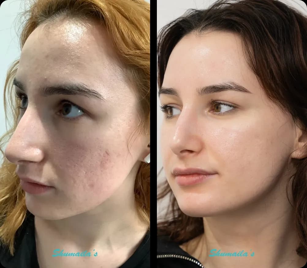 Acne Scar Treatment