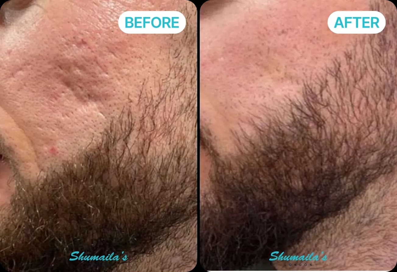 Microneedling