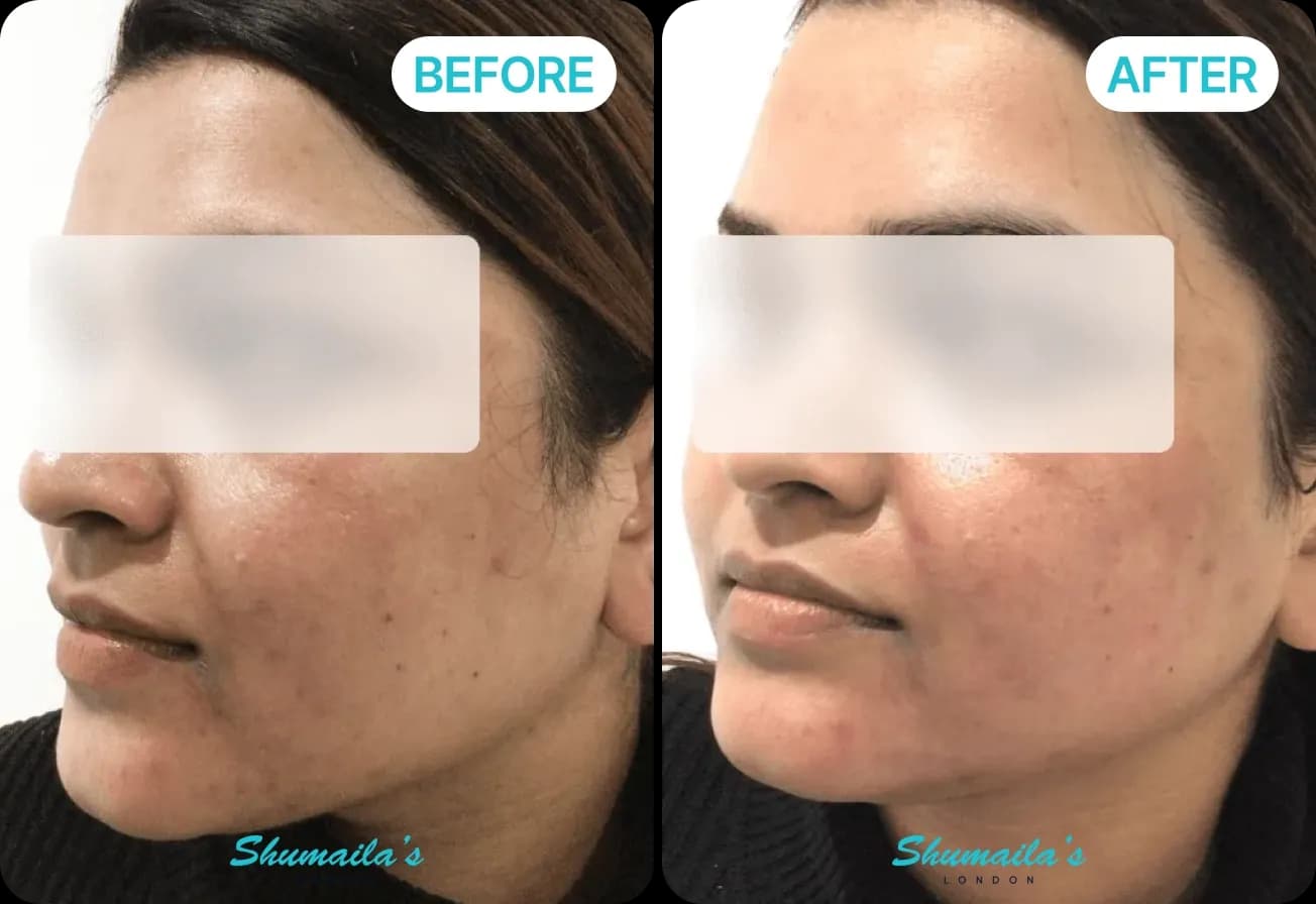 Microneedling
