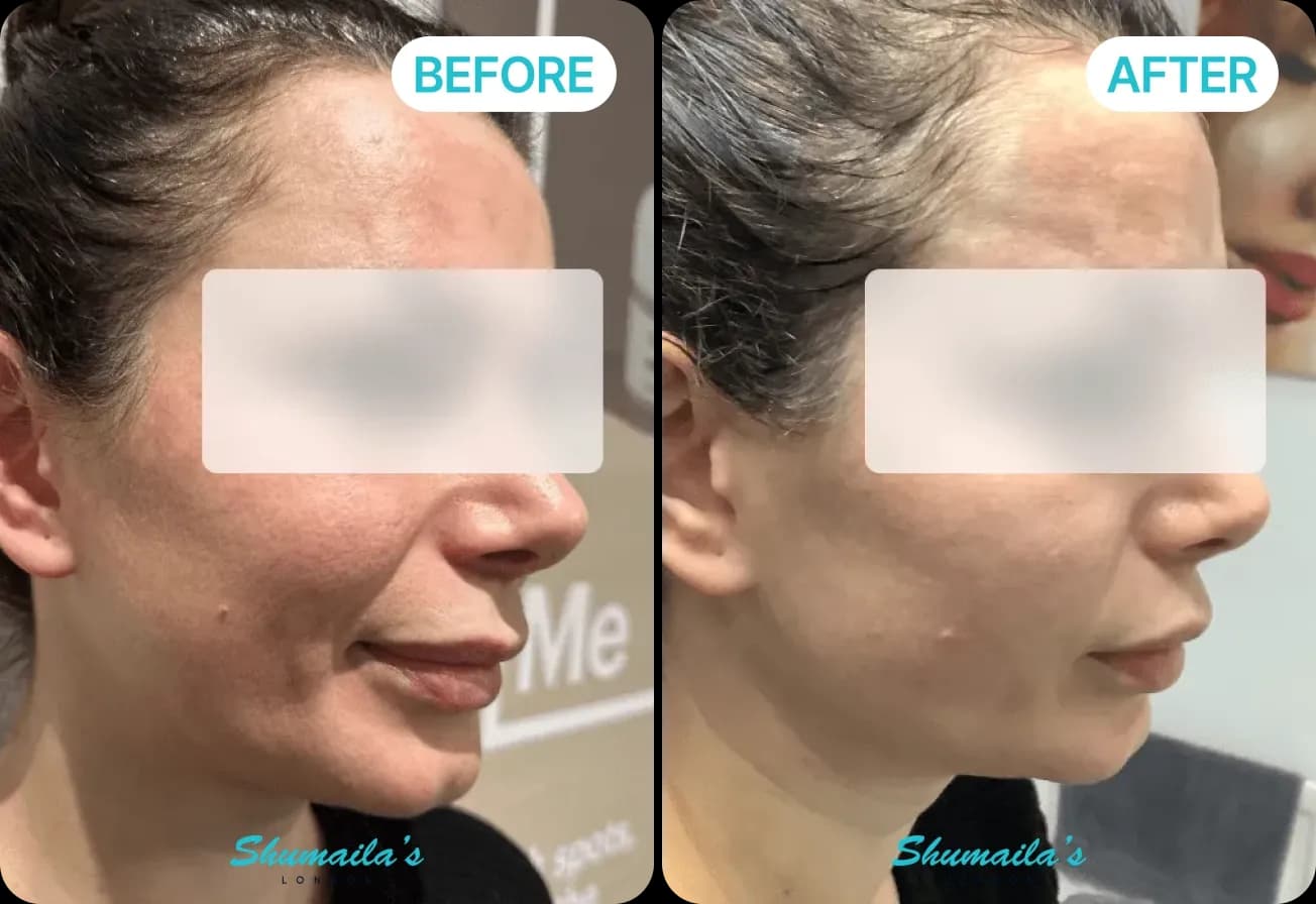 Microneedling