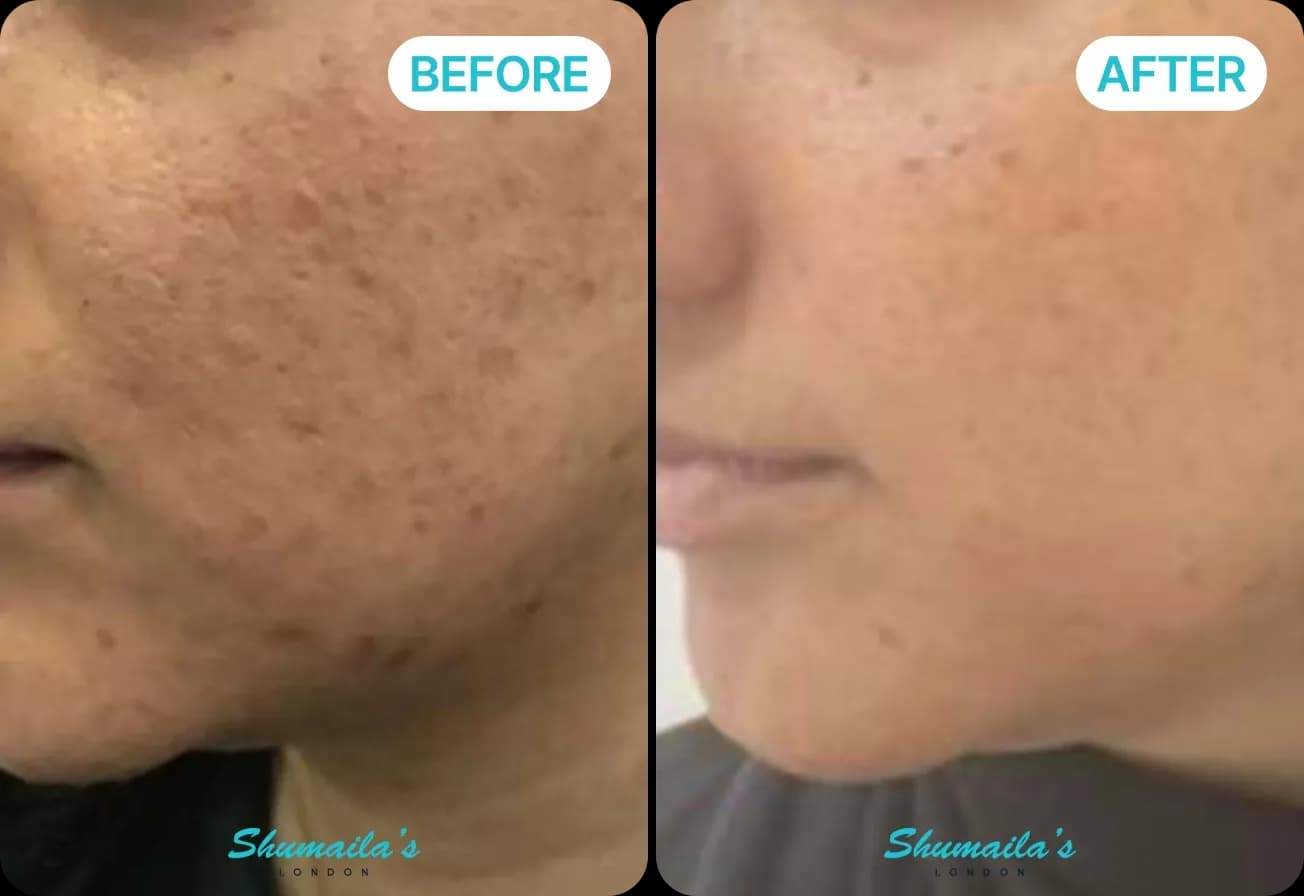 Microneedling