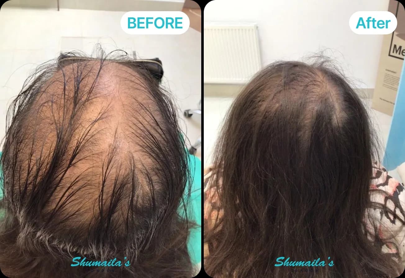 Female Hair Loss Treatment