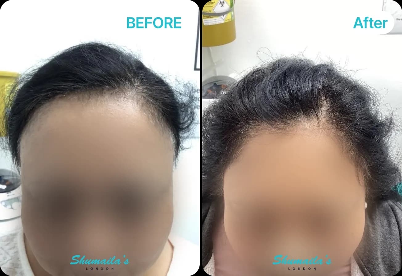 Female Hair Loss Treatment