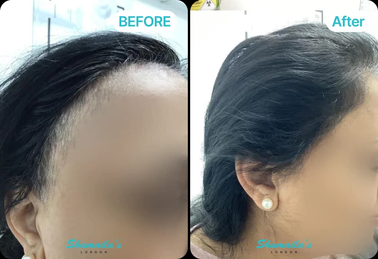 Female Hair Loss Treatment
