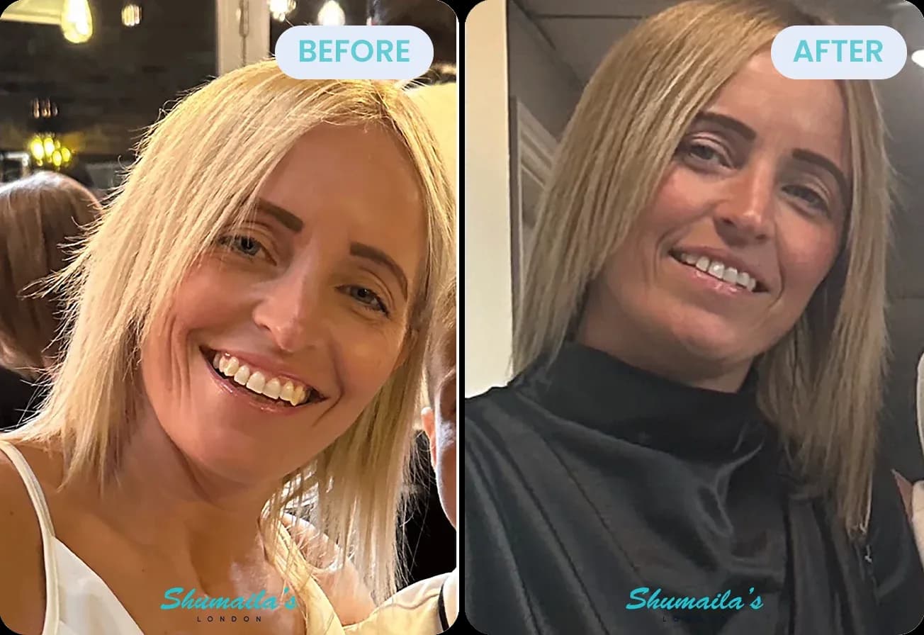 Female Hair Loss Treatment