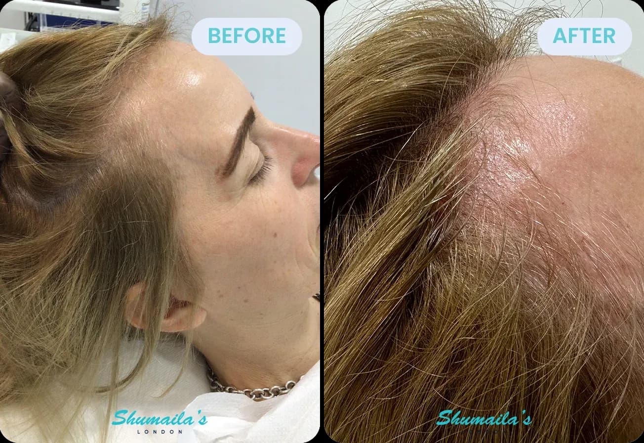 Female Hair Loss Treatment
