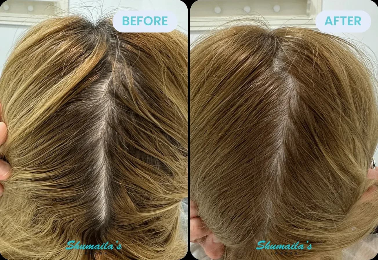 Female Hair Loss Treatment