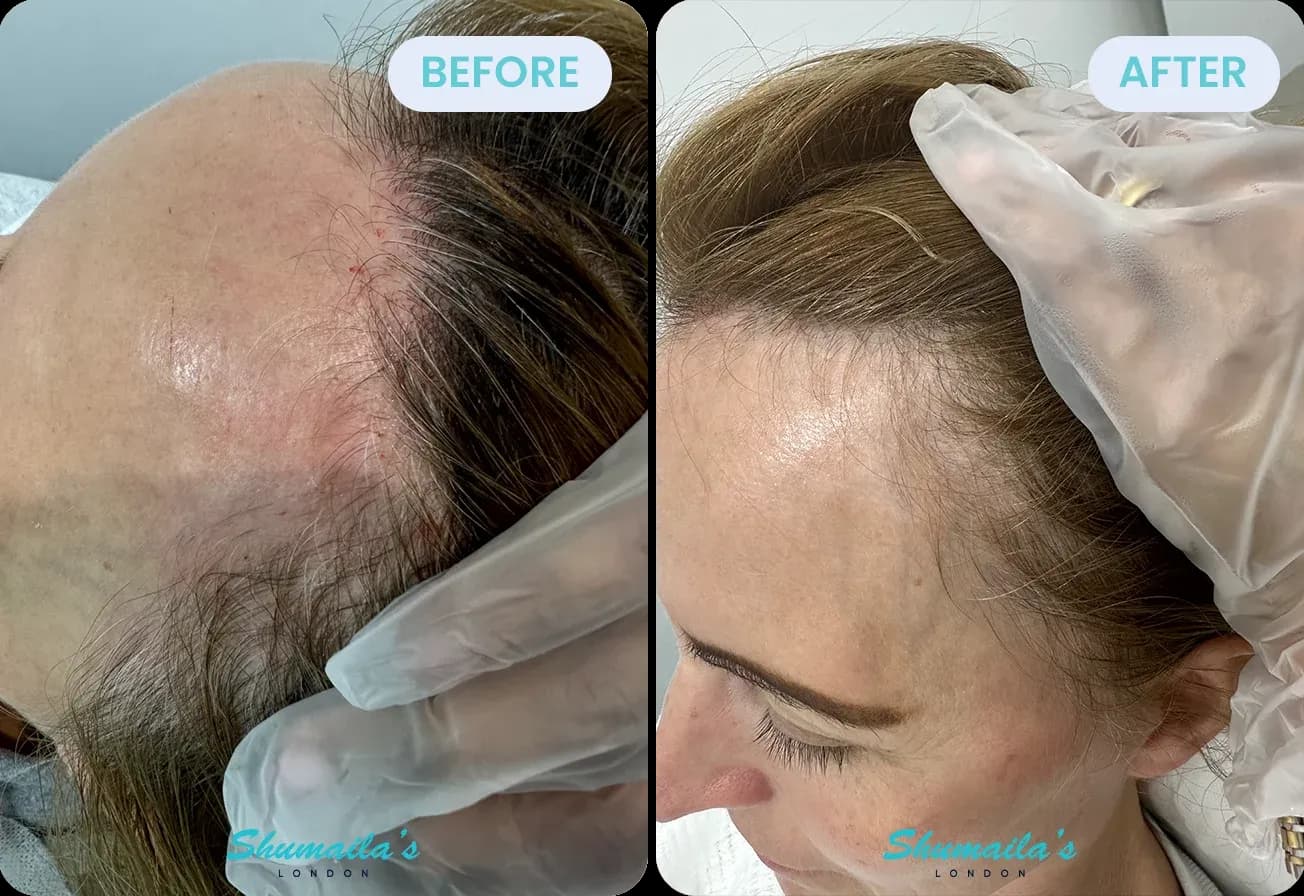Female Hair Loss Treatment