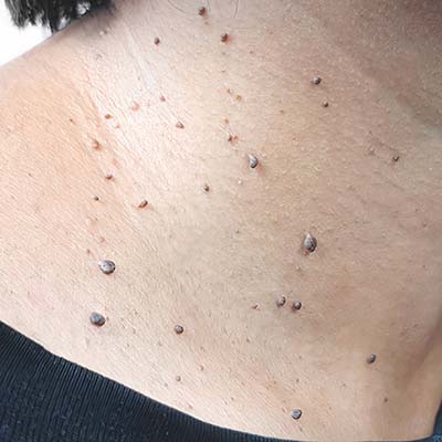 Skin Tag Removal
