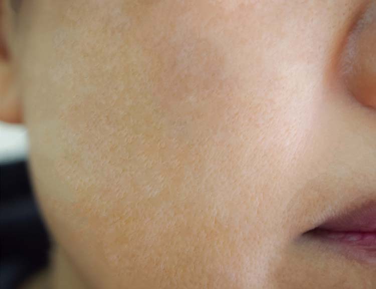 cheek Skin Pigmentation after