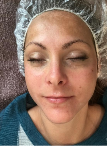 Skin Pigmentation before