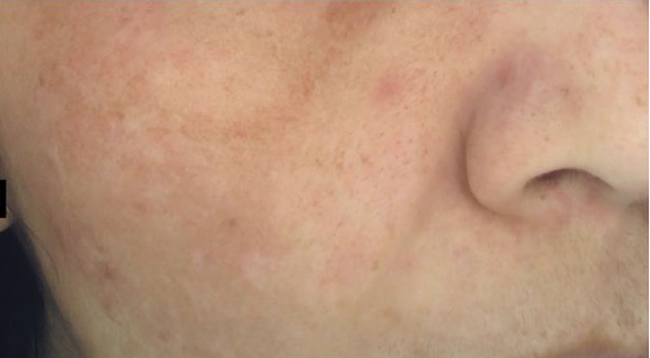 Skin Pigmentation after