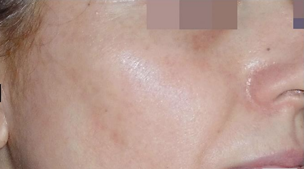 Skin Pigmentation after