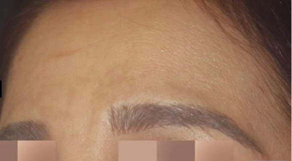 Skin Pigmentation after
