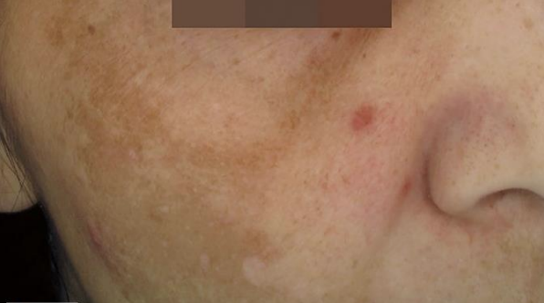 Skin Pigmentation before