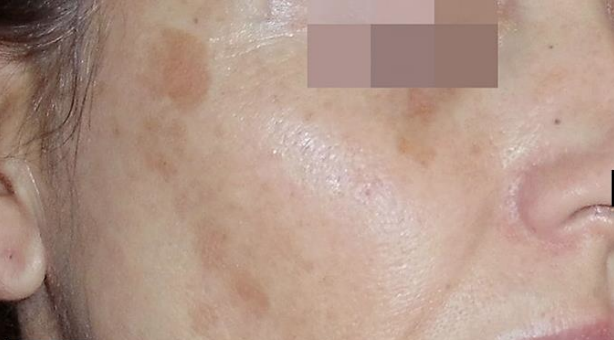 Skin Pigmentation before