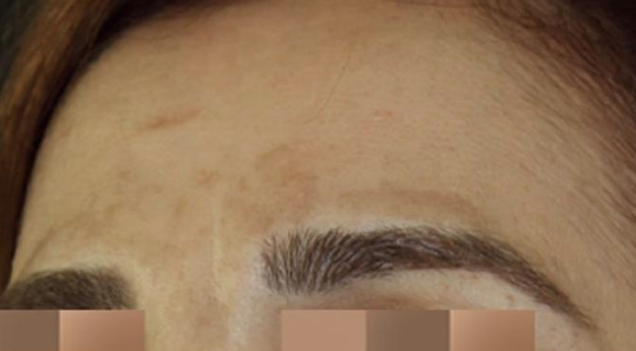 Skin Pigmentation before