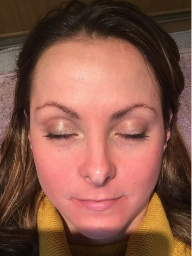 Skin Pigmentation after