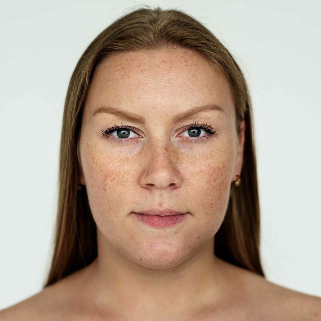 Freckle Removal Treatment | Safe & Effective Solutions