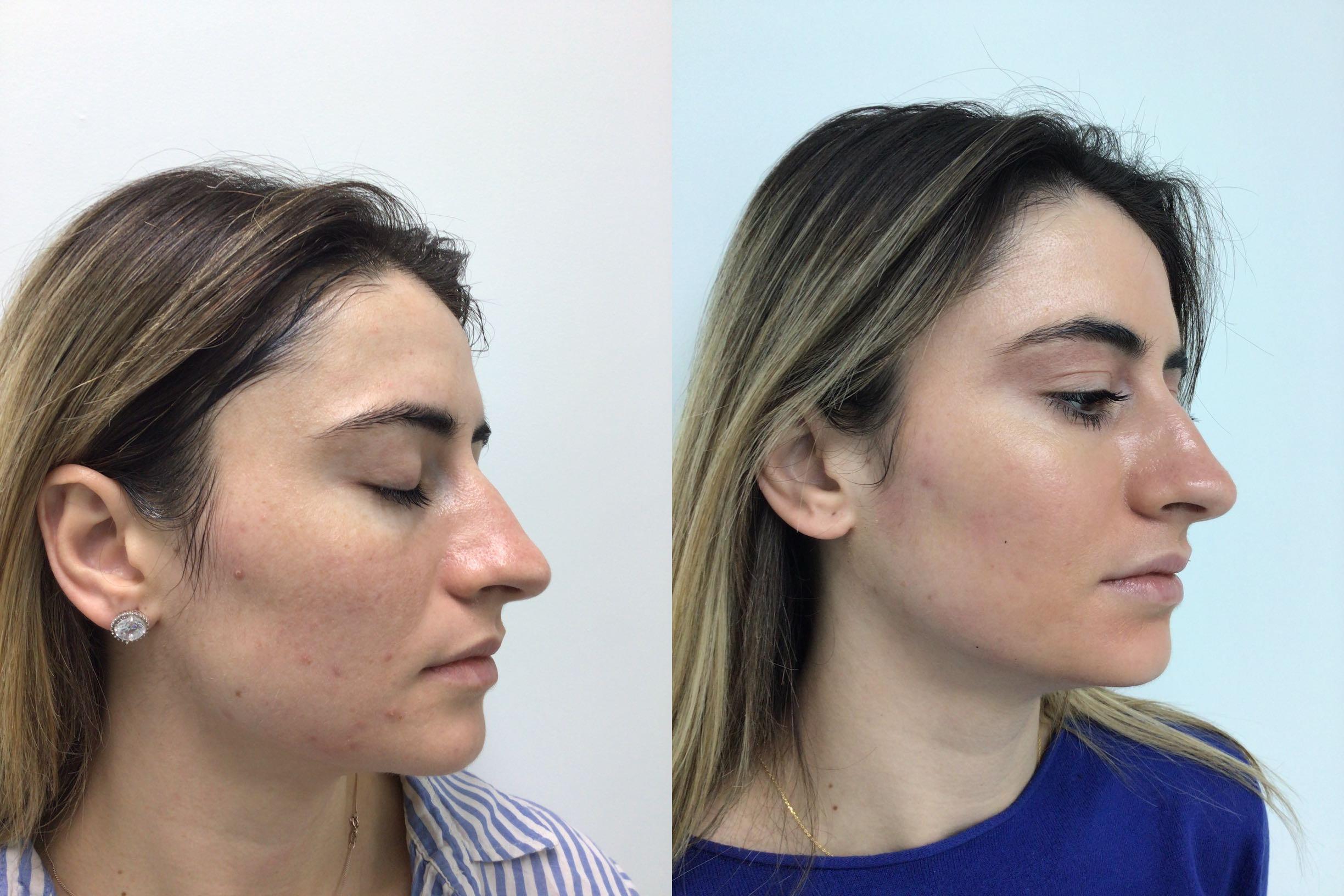 Before and after Cosmelan treatment showing significant reduction in acne marks and pigmentation on a woman's face.